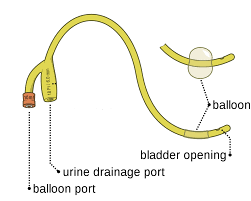 Standard suprapubic catheter problems